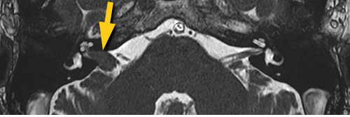 Acoustic Neuroma