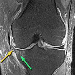 Knee MRI with tears