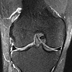 Normal Knee MRI