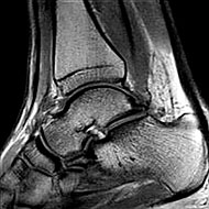 Ankle MRI
